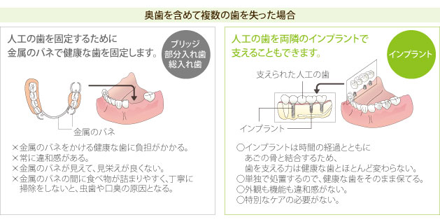 奥歯を含めて複数の歯を失った場合