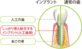 インプラント図